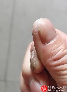 敬修堂灰指甲专用液脱甲膏，灰指甲是怎么引起的插图5